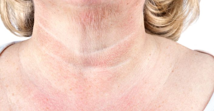 vrásky na krku tech neck